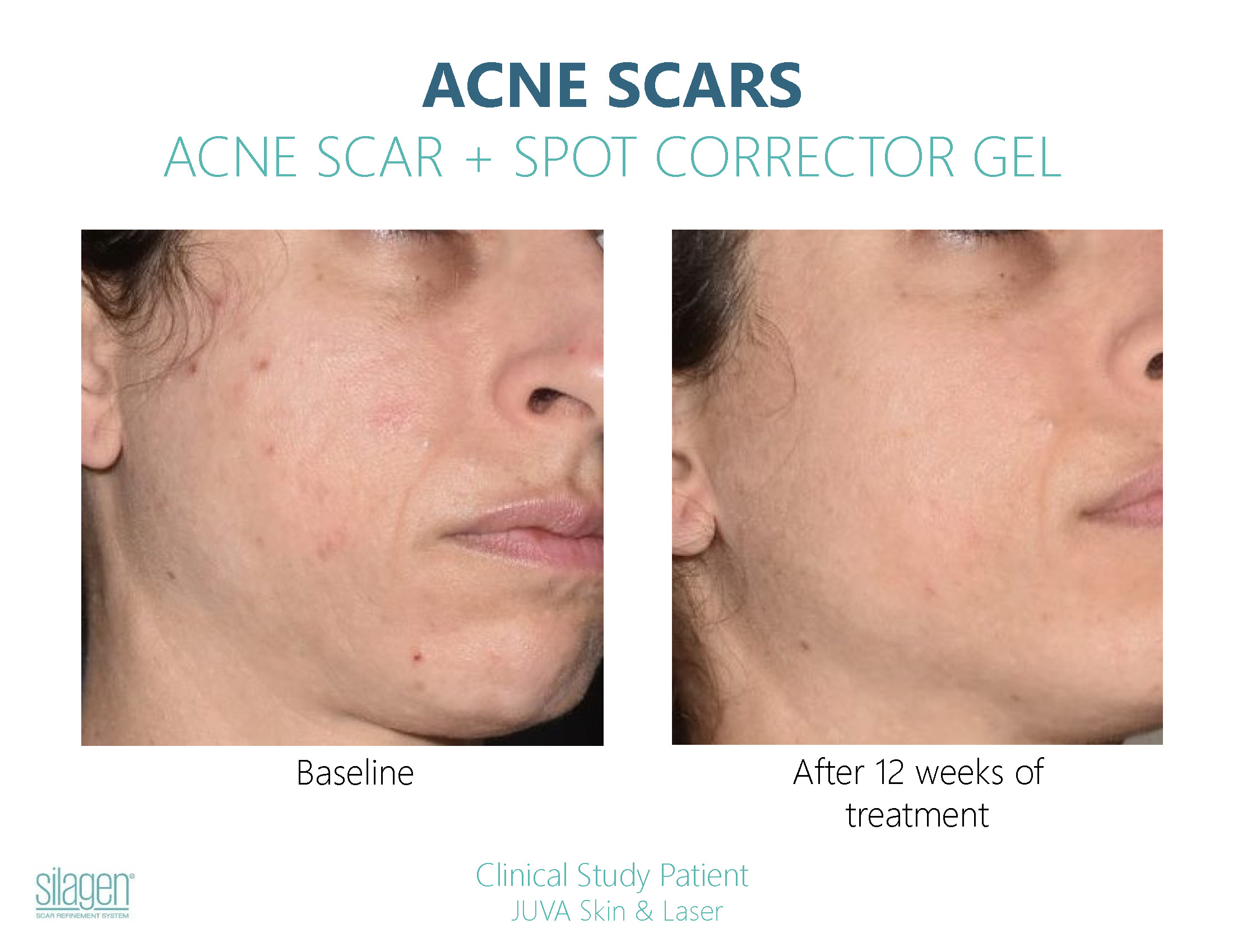 Silagen Acne Scar Before After Photos_Page_3
