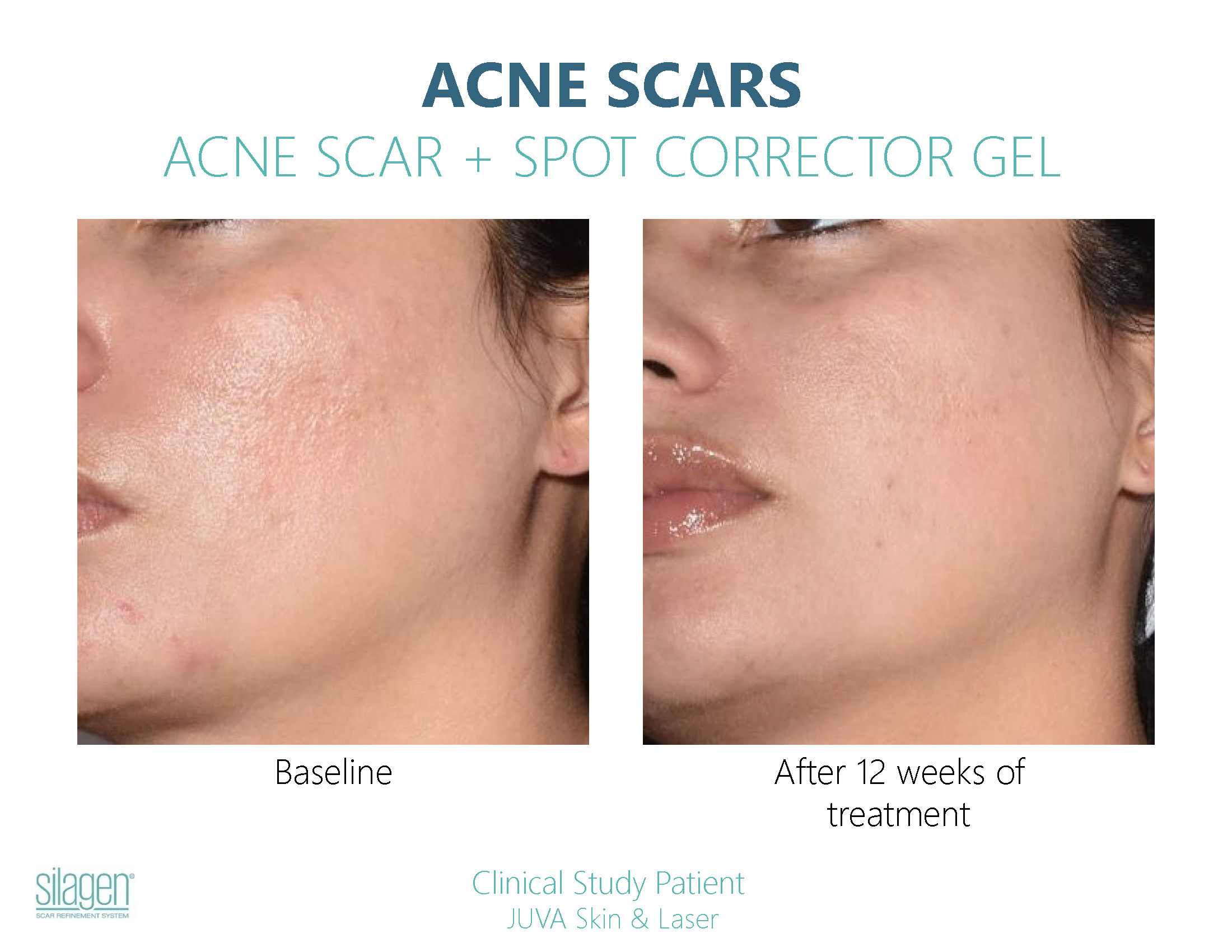 Silagen Acne Scar Before After Photos_Page_5