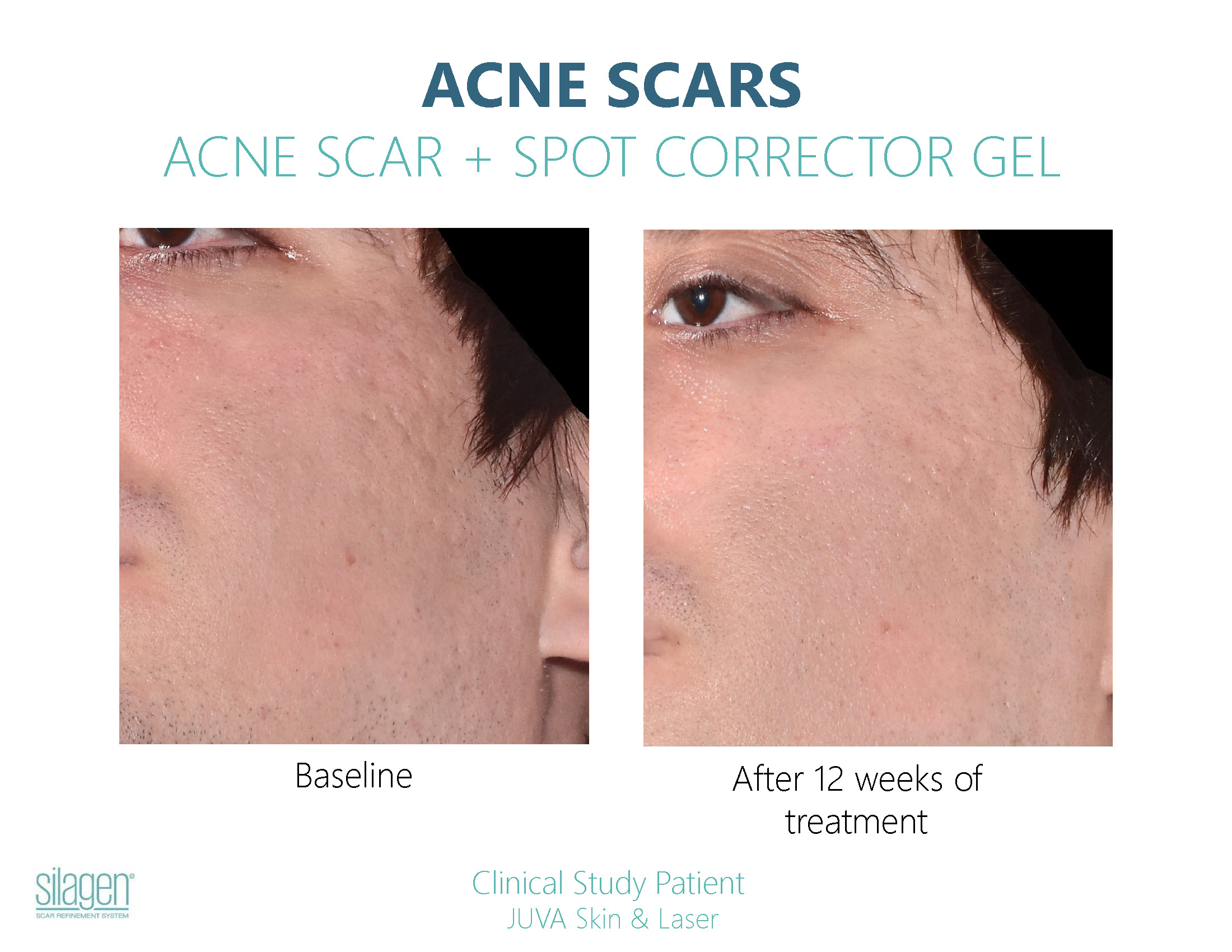 Silagen Acne Scar Before After Photos_Page_7